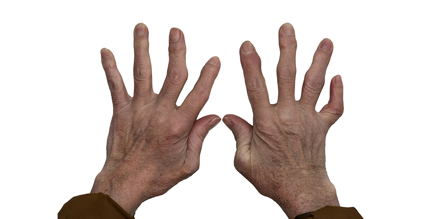 Reumatoid Artritis