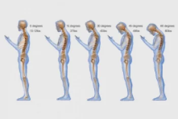 A túlzott mobilozás következménye, a nyaki fájdalom és merevség