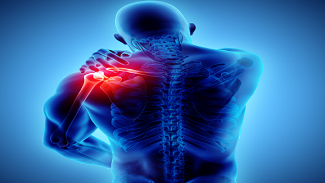 Váll nyáktömlő-gyulladás - Subacromialis bursitis