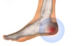 lábfájdalom a sarok ízületében a térdízületeket melyik kenőcs fáj