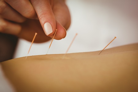 Az akupunktúra segíti az ízületi fájdalmakat
