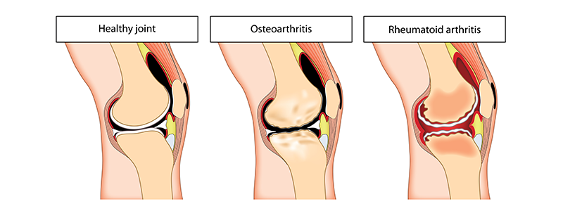 Hatásos-e osteoarthritis esetén az iszap és a só?