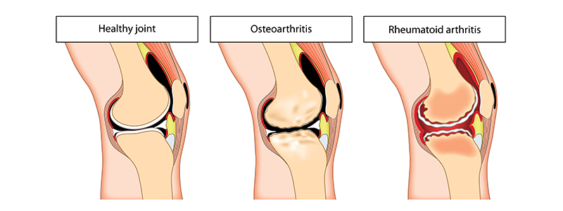 ízületi arthrosis ortopédia