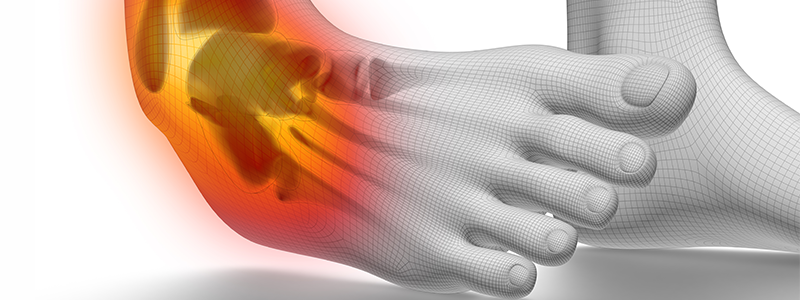 Meddig gyógyul a lábfej sérülése?