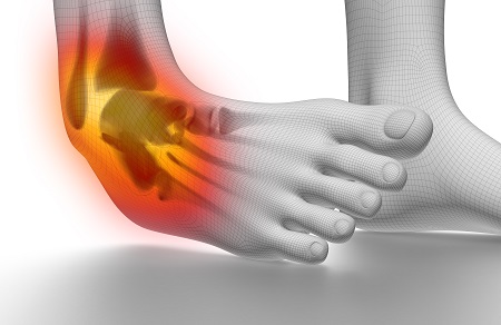 vastagbél boka fájdalom ízületi gyulladás a láb ujján hogyan kell kezelni