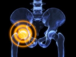 Chondroprotectorek a csípőízület coxartrózisában - Osteoarthritis
