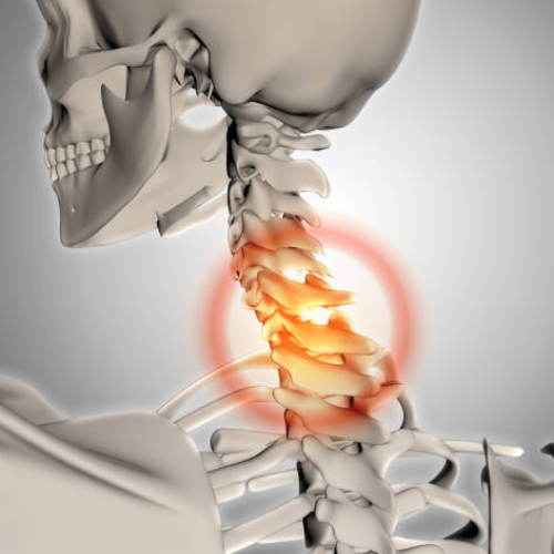 Nyaki gerincsérv tünetei - Fájdalom Központ