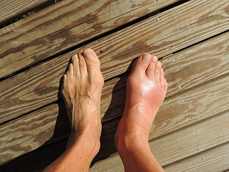 A nagy lábujjhegy ütése - A nagy lábujj ízülete bumpot okoz