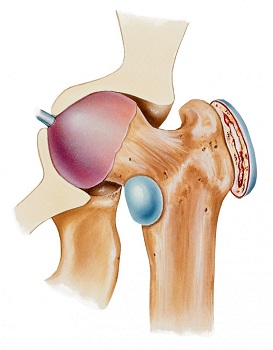poszttraumás deformáló artrózis a könyökízületben miért fájnak folyamatosan a csípőízületek