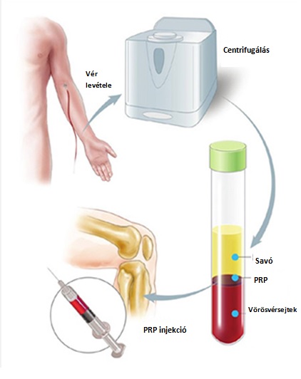 PRP ízületi injekció | PRP kezelés